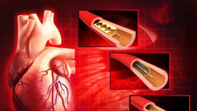 Le faux mythe du cholestérol et les maladies cardiaques
