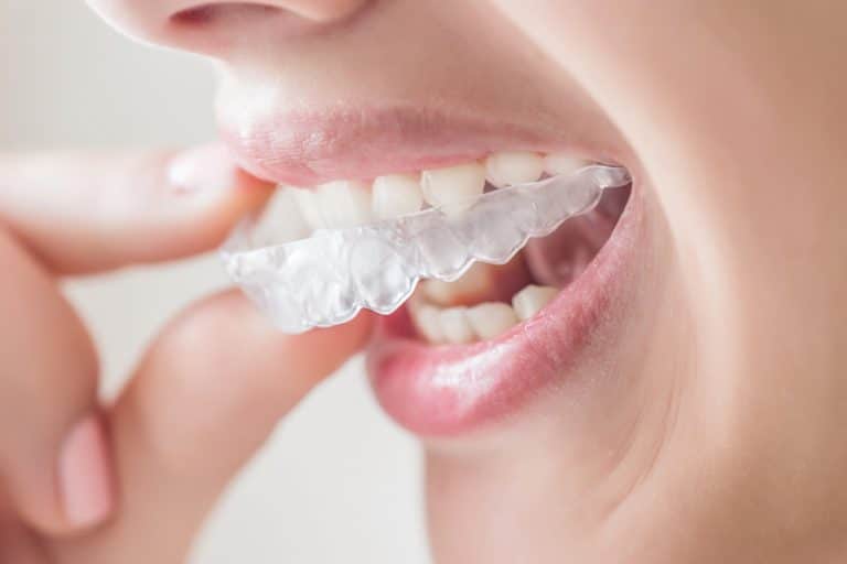 Qu&rsquo;est-ce que l&rsquo;orthodontie invisible ?